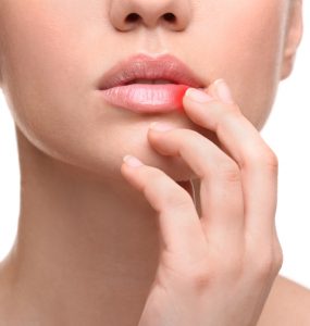 Woman with cold sore touching lips