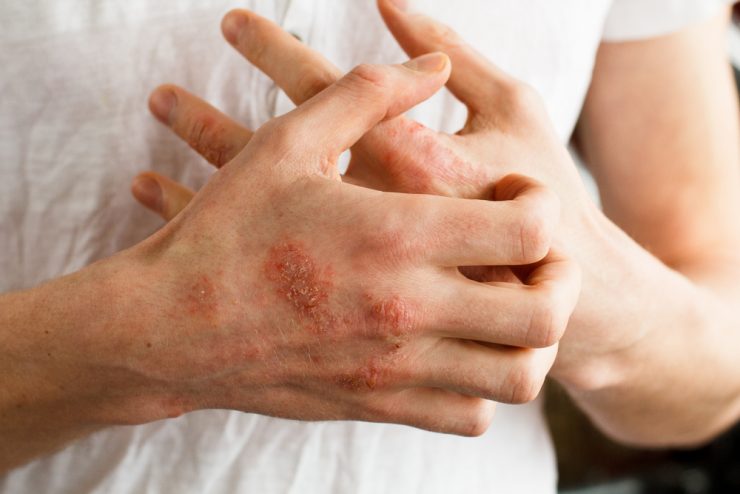 Close up of hands with eczema itching