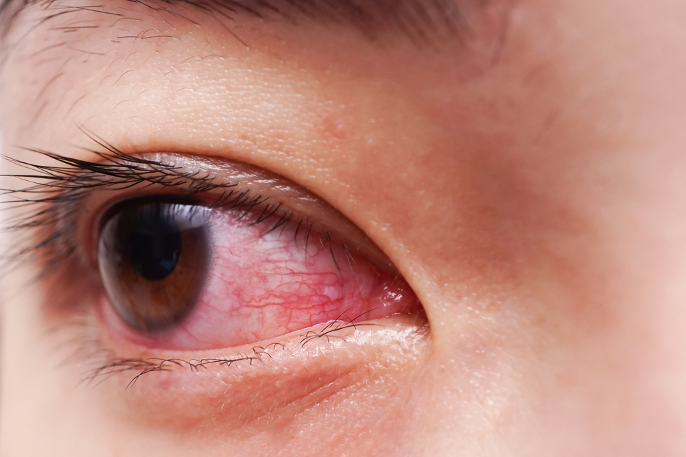 Close up of a bloodshot eye