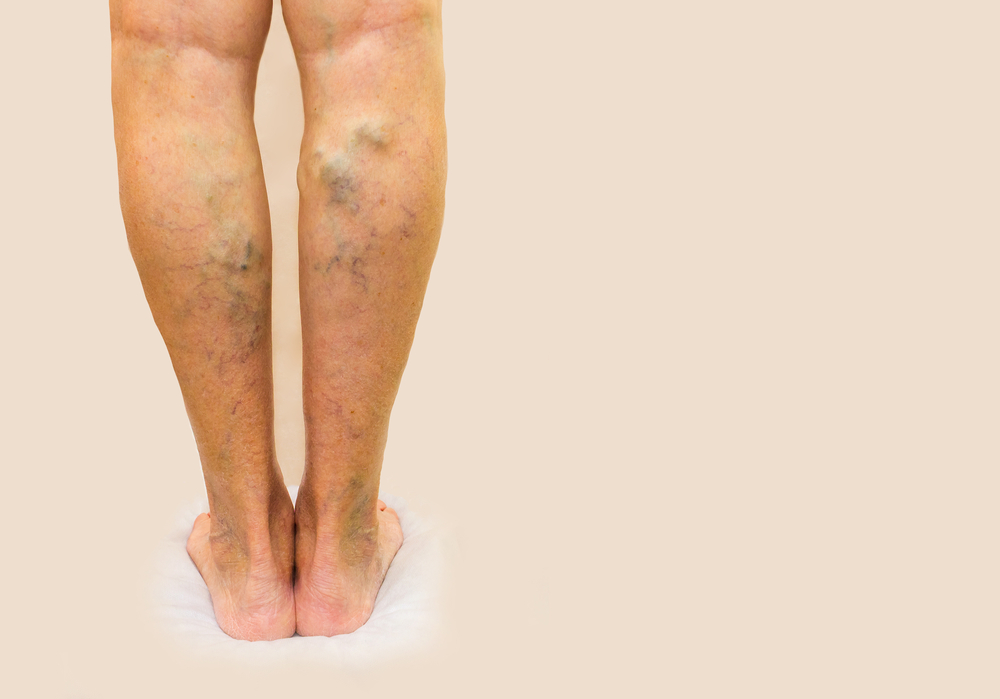 Close up of woman's legs showing varicose veins