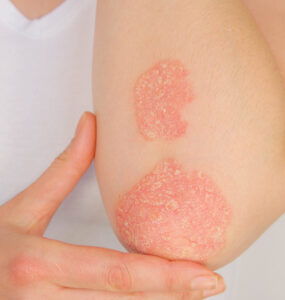Close up of arm with psoriasis
